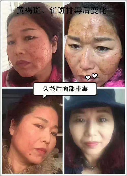 用福善膏做面部排毒,前后效果对比图,喜俏颜脸部排毒抗衰液案例,使用