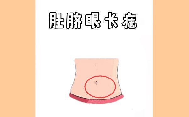 肚脐眼长痣