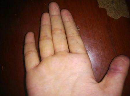 麻烦大家帮助我看看10岁孩子图片里手指肚是怎么回事该怎样办