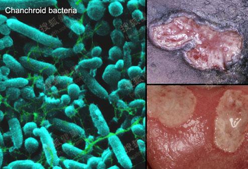 男性症状:阴茎上