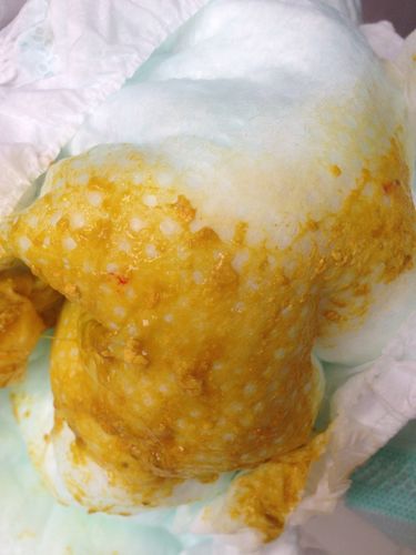 宝宝大便有血,你们的宝宝有这个情况吗?有图!