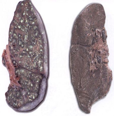 2019年矽肺病人待遇政策 有矽肺投什么保险