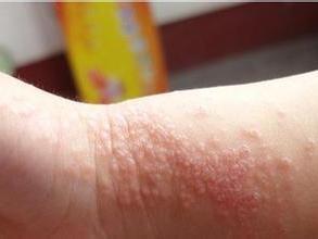 皮炎常见并发症是什么