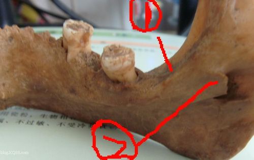 5cm,成人在下颌第二前磨牙的下方或第一,二磨牙之间的下方.