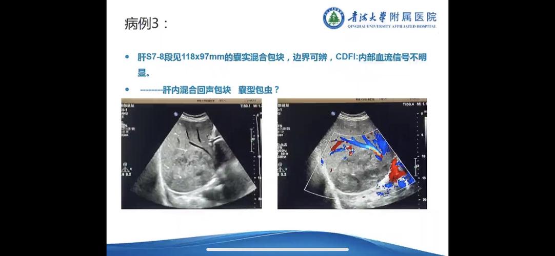 肝包虫病的超声分型与鉴别诊断