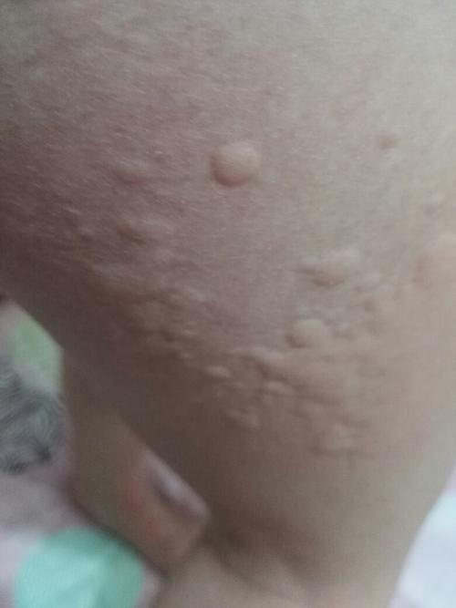 大腿上全是疙瘩,请问这是什么过敏,我要知道这是什么引起的,主要是