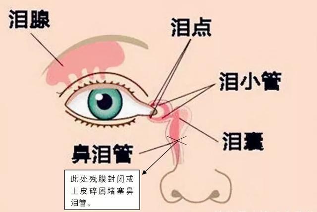 泪管在鼻腔的下端出口被先天性膜组织所封闭或因上皮碎屑堵塞管道