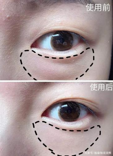 刚开始眼部出现的细纹,多数是假性干纹,这个时候如果给肌肤补充足够的