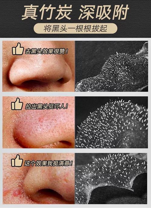 鼻贴去黑头神器去粉刺男女猪鼻贴撕拉式祛黑头贴鼻子