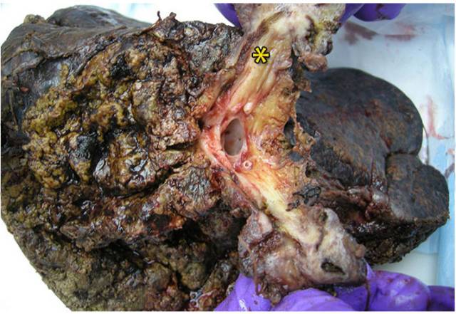 14种常见肝脏良恶性肿瘤图解