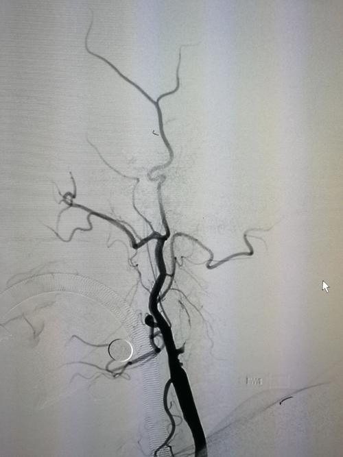 左侧颈动脉造影,颈内动脉起始部闭塞