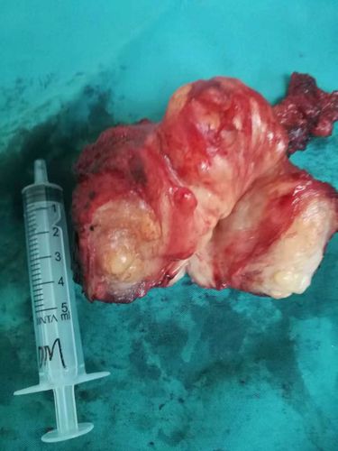 切除的前列腺及肿瘤组织