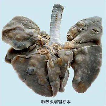 并殖吸虫寄生于肺部,常引起 咳嗽, 胸痛,咳铁锈色痰