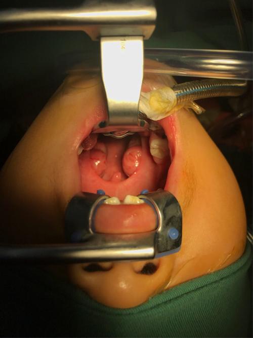 邢台市人民医院耳鼻喉科等离子射频消融扁桃体及腺样体治疗小儿鼾症