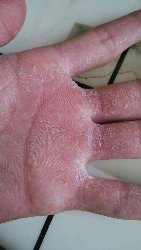 这手一年都在掉皮是什么原因啊!