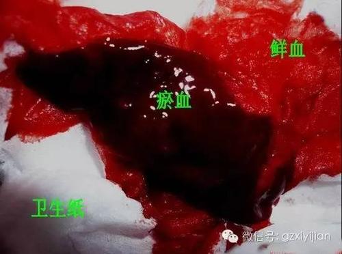 排瘀疗法是在中医刺络放血疗法基础上经过多年的研究创立的新型医疗