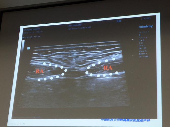 产后腹直肌分离和耻骨联合分离的超声诊断——董梦