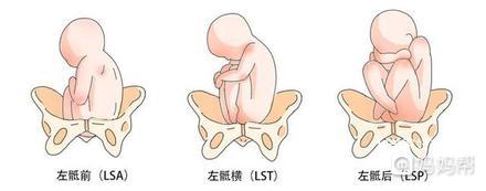 胎位roa和loa的区别是什么?来看看专家是怎么说的