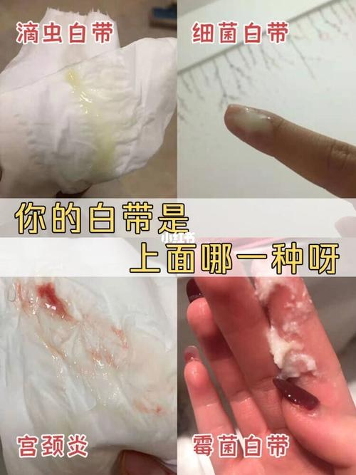 是霉菌,还是滴虫?_内裤_私处_洗液