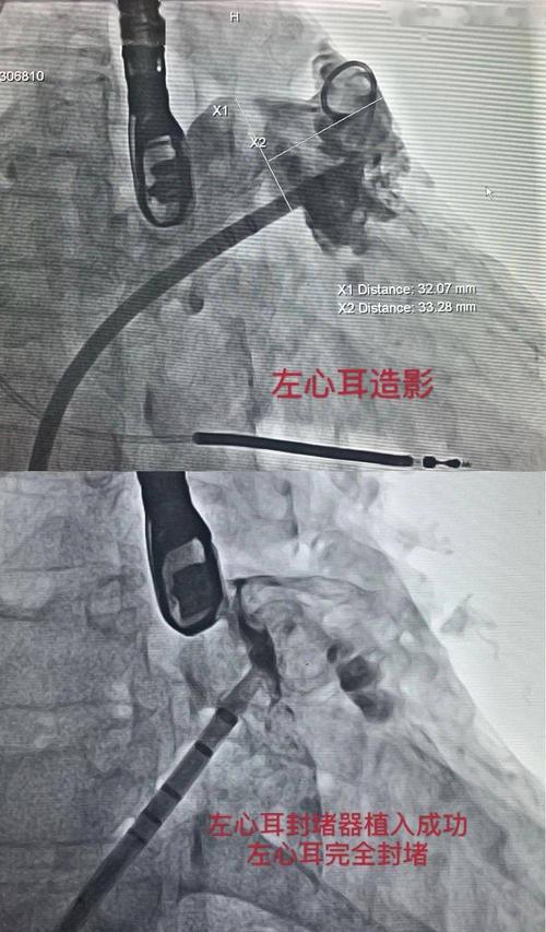 左心耳封堵术:从源头拦截血栓