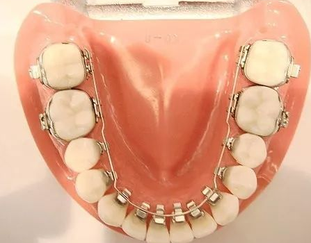 舌侧隐形矫正是什么样的牙齿矫正方法?