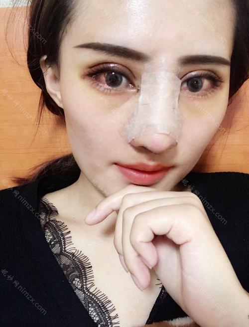 重庆潘多拉修复整形美容诊所黄金龙鼻部多项成功案例术后97天前后照