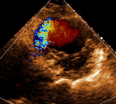 【病例分享】超声心动图诊断急性心肌梗死合并室间隔穿孔