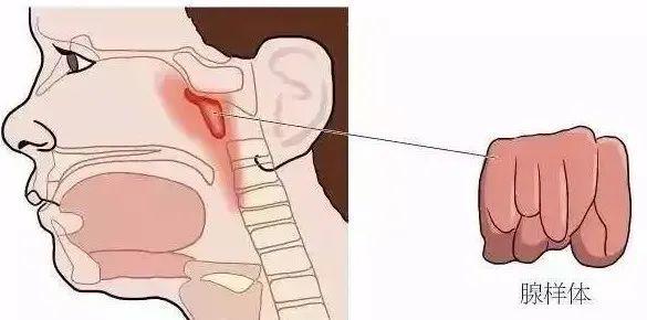 你知道吗孩子张嘴睡觉可能是种病会变丑的病