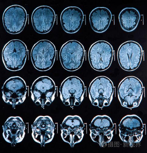 磁共振成像大脑扫描