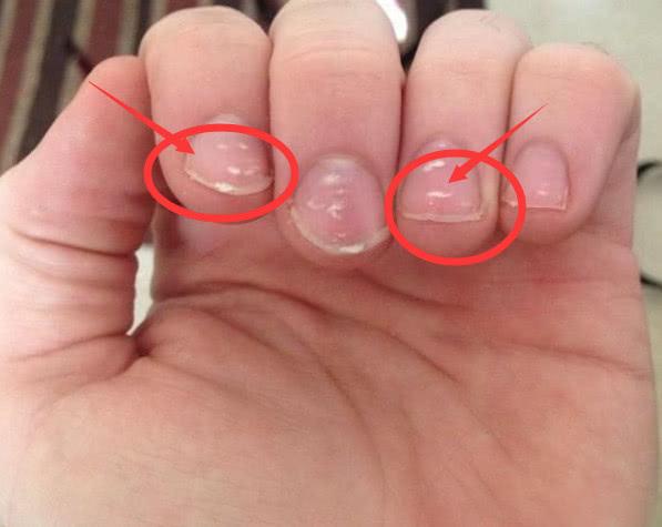 "尿毒症"进门时,手上若有"3红灯",肾脏或即将"病变"