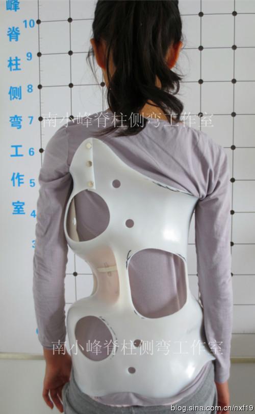 12岁西安女孩脊柱侧弯支具矫形一例报告