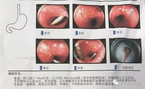 将其咽下去,或者喝醋试图让鱼骨软化,其实这是错误的行为,如果异物