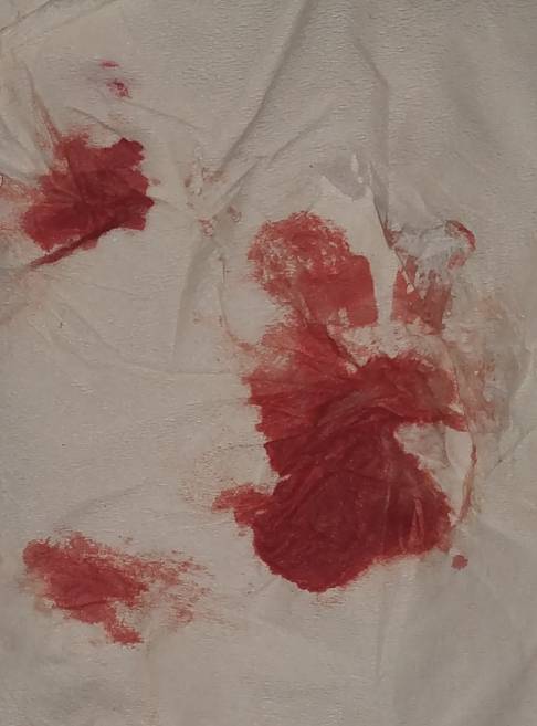 今天拉完大便擦屁股,卫生纸上粘了鲜血(如图),我身体到底出什么状况了