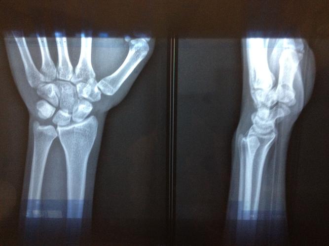 今天去拍了腕关节的x光片想看自己的骨龄,但是医院的大夫说自己没学过