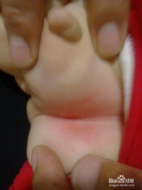 宝宝隐私部位淹怎么办,怎么解决宝宝淹这个问题