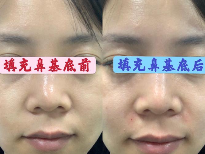 婕尔玻尿酸填充鼻基底无美颜真实分享