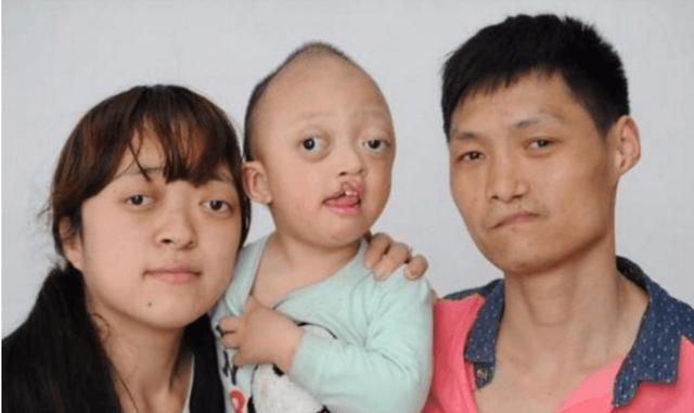 小男孩出生身上就发现多处缺陷,都是遗传了父母身上的缺陷