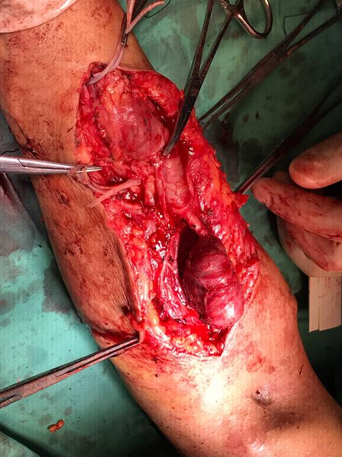 患者,男性,47岁,右前臂动静脉内瘘九年,内瘘假性动脉瘘形成一年余,内