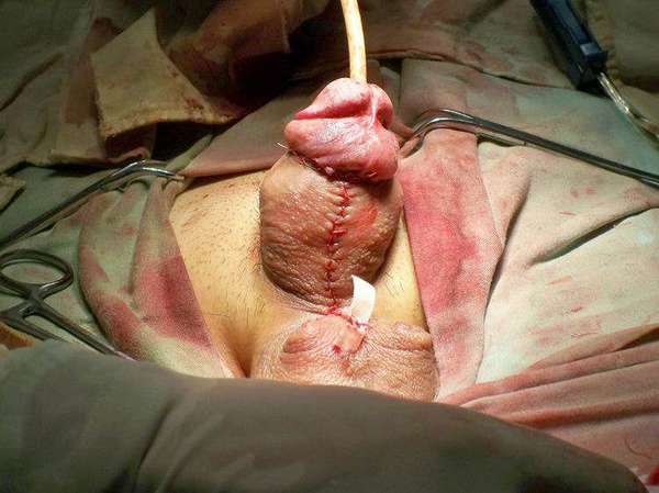 蹼状阴茎又称阴茎阴囊融合, 是指阴囊中隔皮肤与阴茎腹侧皮肤