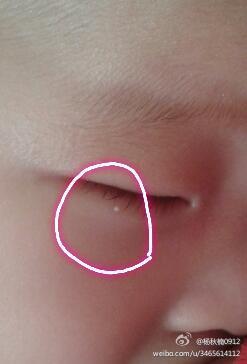 崔大夫,您好,宝宝下眼皮有个白点,就像成人的脂肪粒,请问这个也是脂肪