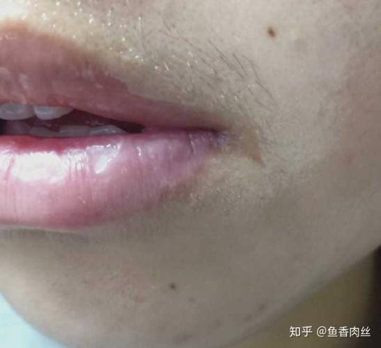 女孩子的唇毛很重怎么办?