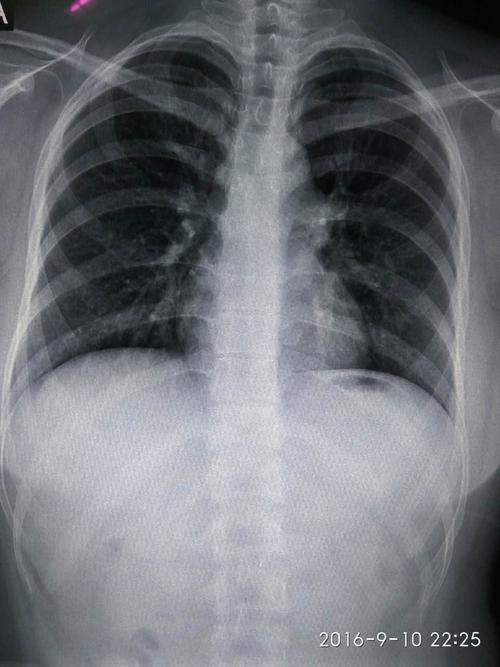 28岁女 图一是胸片 图二是医生画的小圈那个地方是觉得有问题的地方