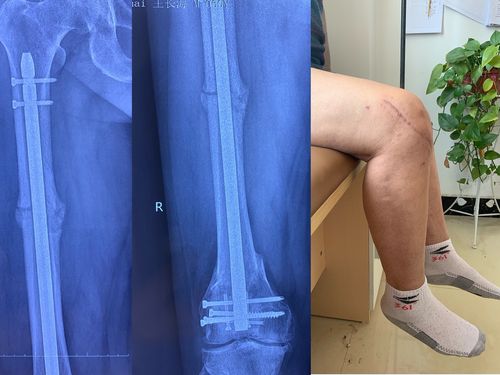 术后3个月骨痂形成及功能照!