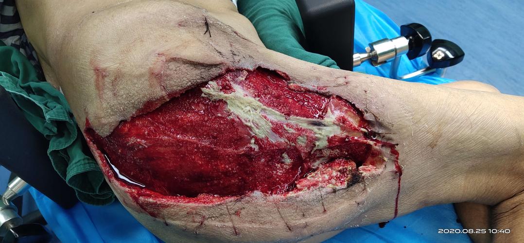 臀部蜂窝组织炎的治疗