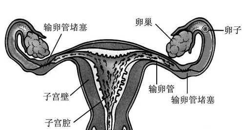 4.盆腔粘连