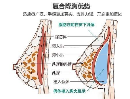 脂肪丰胸,假体隆胸,复合隆胸你适合哪种?自己在家也能