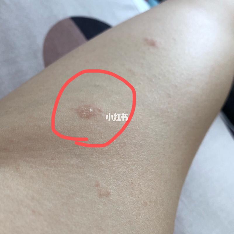 第一次得玫瑰糠疹,记录一下