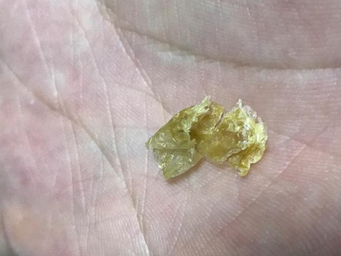 耳屎呈片状是怎么了?(图片会让人感到不适,慎点)