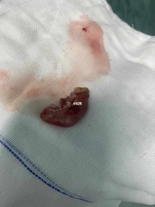 子宫内膜息肉宫腔镜手术_子宫_葡萄糖_内膜息肉_医疗健康_医疗健康