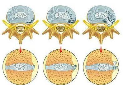 简单的说:膨出和突出最大的区别在于纤维环是否已经破裂,如果没有破裂